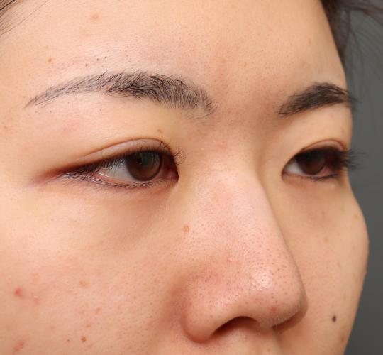 20代女性の目つき矯正 Before 症例写真