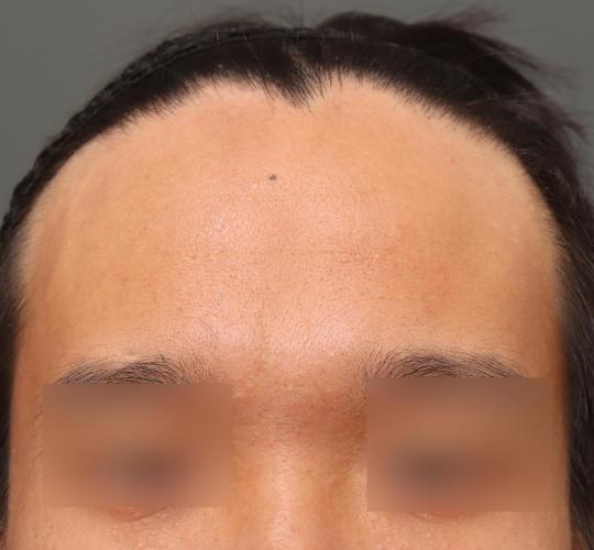 30代男性の額縮小 Before 症例写真