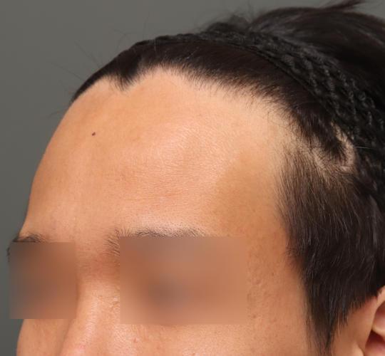 30代男性の生え際前進術 Before 症例写真