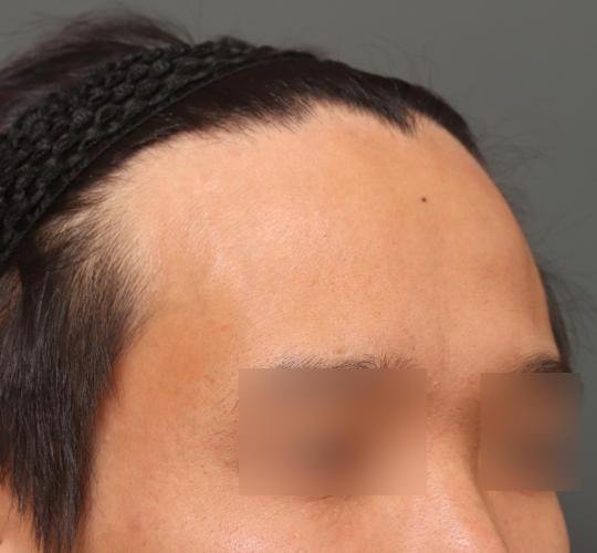 30代男性の生え際前進術 Before 症例写真