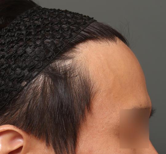 30代男性の生え際前進術 Before 症例写真