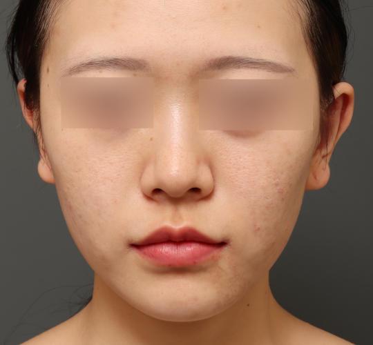 20代女性の唇・口元の整形 After 症例写真