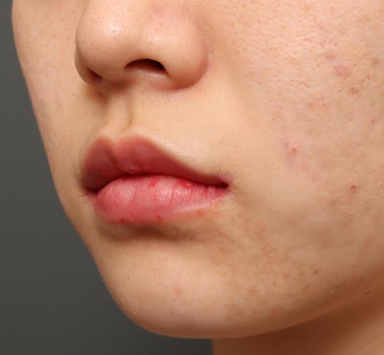 20代女性の口角挙上（スマイルリップ） After 症例写真