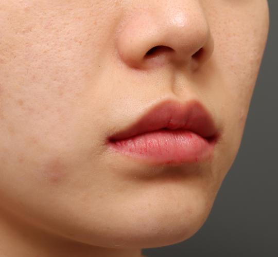 20代女性の口角挙上（スマイルリップ） After 症例写真