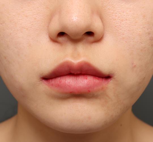 20代女性の口角挙上（スマイルリップ） After 症例写真