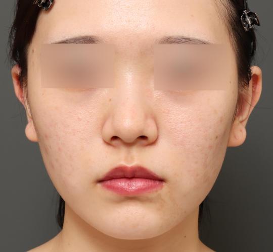 20代女性の唇・口元の整形 Before 症例写真