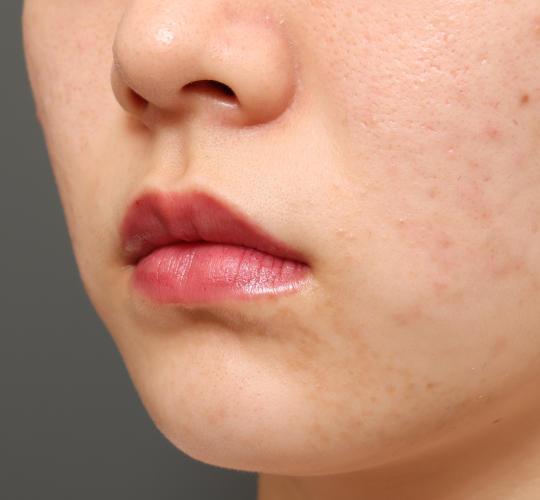20代女性の口角挙上（スマイルリップ） Before 症例写真