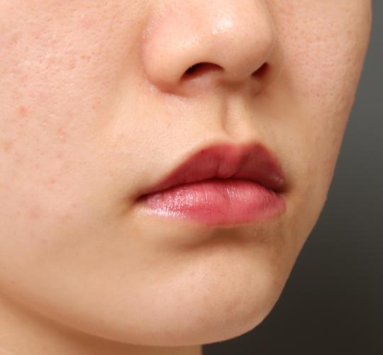 20代女性の口角挙上（スマイルリップ） Before 症例写真