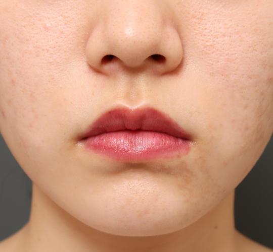 20代女性の口角挙上（スマイルリップ） Before 症例写真