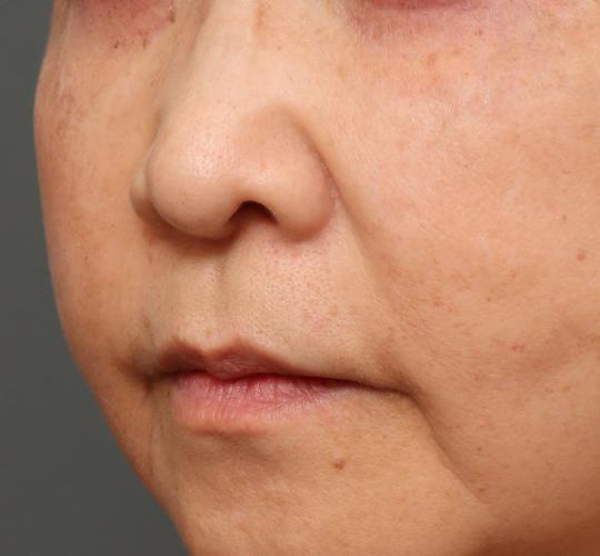 60代女性の下まぶたのたるみ取り After 症例写真