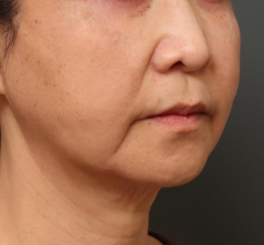 60代女性の下まぶたのたるみ取り After 症例写真