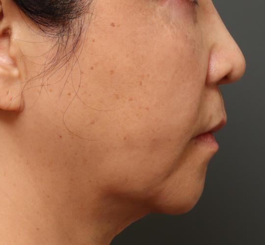 60代女性の下まぶたのたるみ取り After 症例写真