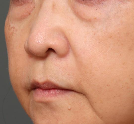 60代女性の下まぶたのたるみ取り Before 症例写真