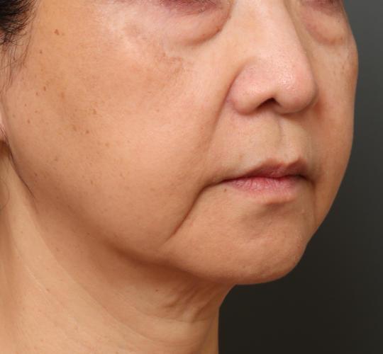 60代女性の下まぶたのたるみ取り Before 症例写真