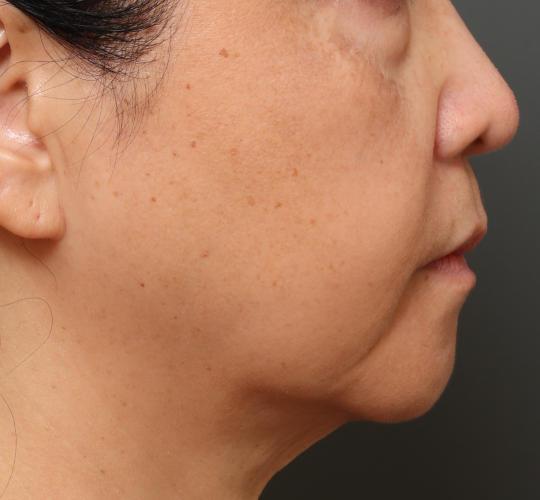 60代女性の下まぶたのたるみ取り Before 症例写真