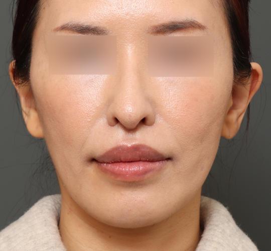 40代女性の鼻翼縮小(小鼻縮小) After 症例写真