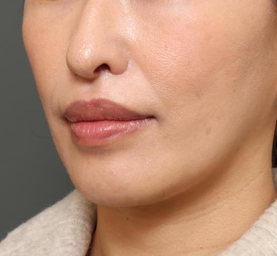 40代女性の鼻翼縮小(小鼻縮小) After 症例写真