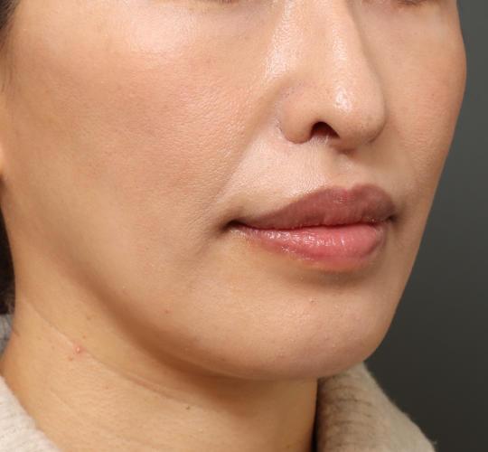 40代女性の鼻翼縮小(小鼻縮小) After 症例写真