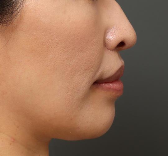 40代女性の鼻翼縮小(小鼻縮小) After 症例写真