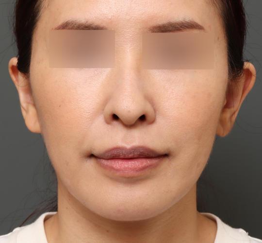 40代女性の鼻翼縮小(小鼻縮小) Before 症例写真
