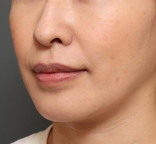 40代女性の鼻翼縮小(小鼻縮小) Before 症例写真