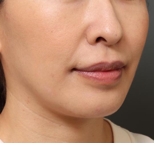 40代女性の鼻翼縮小(小鼻縮小) Before 症例写真