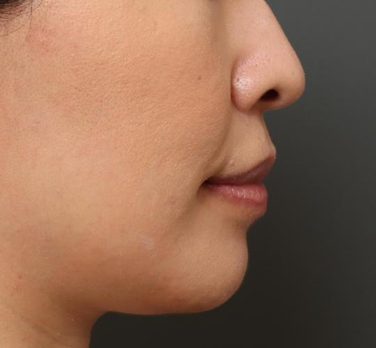 40代女性の鼻翼縮小(小鼻縮小) Before 症例写真