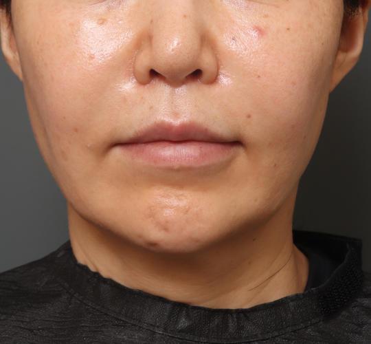 50代女性の人中短縮（リップリフト） After 症例写真