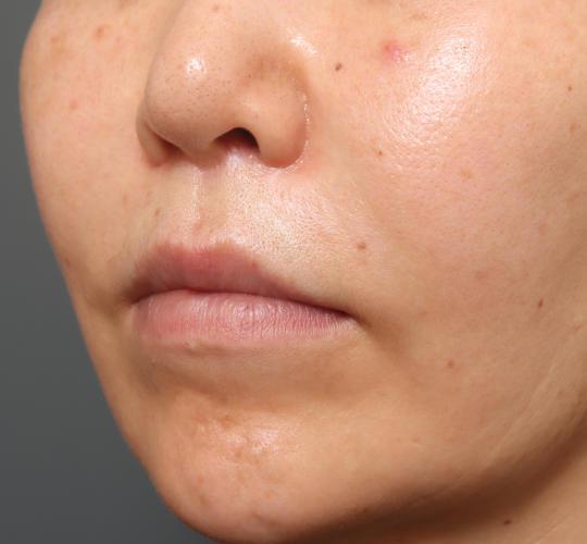50代女性の唇・口元の整形 After 症例写真