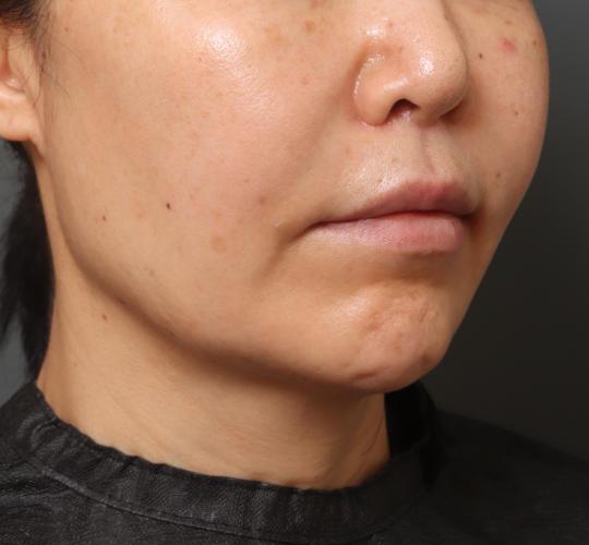 50代女性の人中短縮（リップリフト） After 症例写真