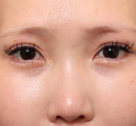 20代女性の二重整形・目元の整形 After 症例写真