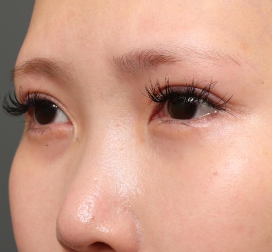 20代女性のタレ目・でか目形成 After 症例写真