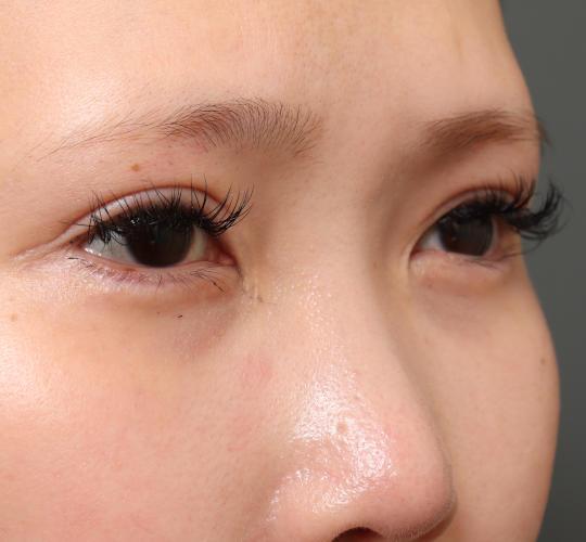 20代女性のタレ目・でか目形成 After 症例写真