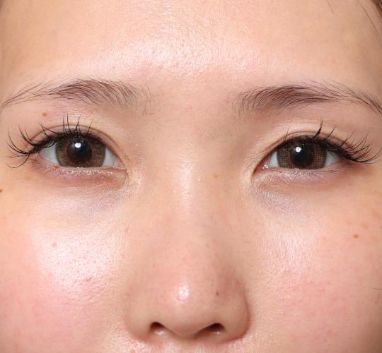 20代女性の二重整形・目元の整形 Before 症例写真