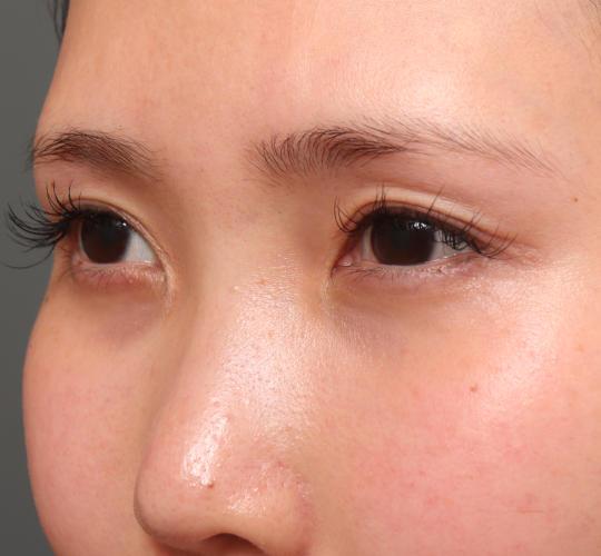 20代女性のタレ目・でか目形成 Before 症例写真