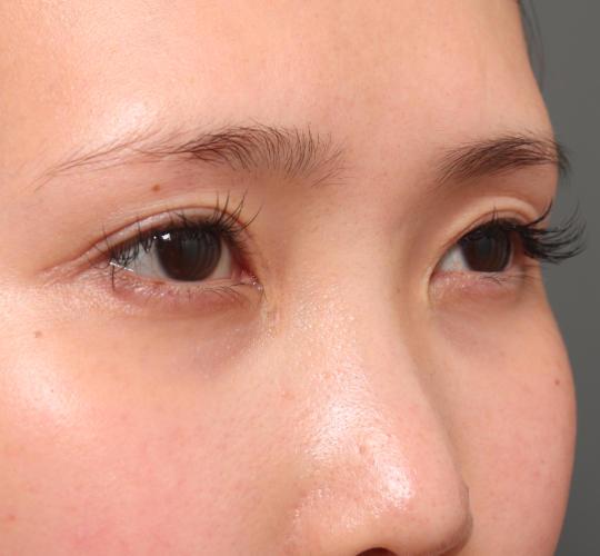 20代女性のタレ目・でか目形成 Before 症例写真