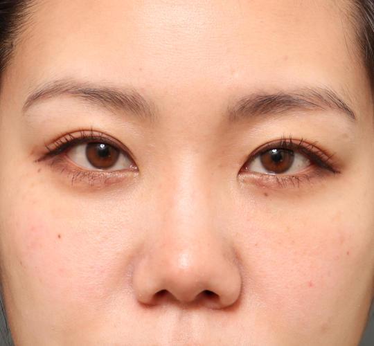 30代女性の3Dリポアイリフト After 症例写真