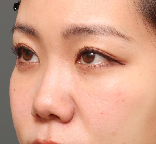 30代女性の3Dリポアイリフト  After 症例写真