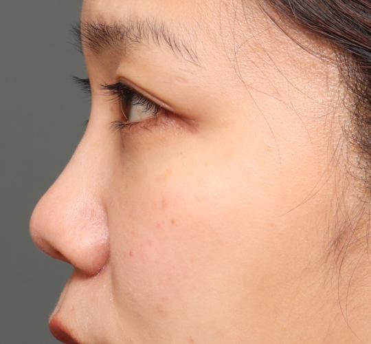 30代女性の3Dリポアイリフト  After 症例写真