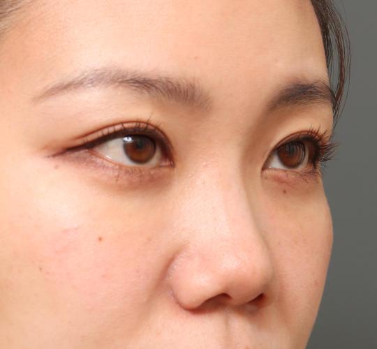 30代女性の3Dリポアイリフト  After 症例写真