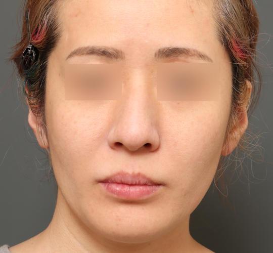 30代女性の美肌治療 After 症例写真