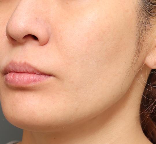 30代女性の肌管理毛穴スリークスキン（ダーマペン4） After 症例写真