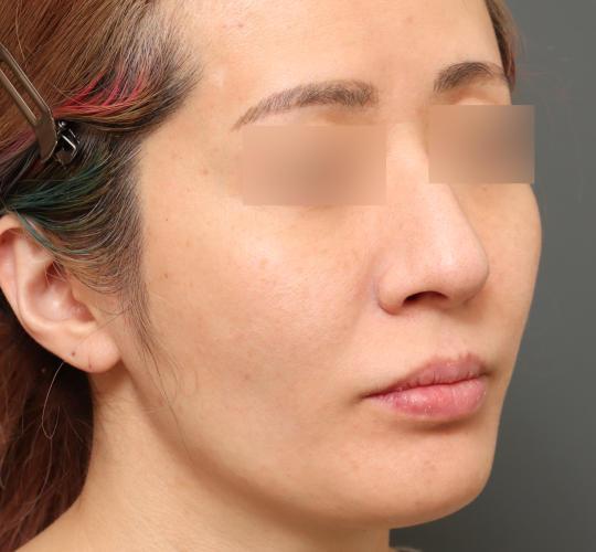 30代女性の肌管理毛穴スリークスキン（ダーマペン4） After 症例写真