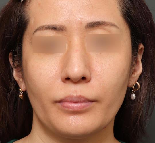 30代女性の美肌治療 Before 症例写真