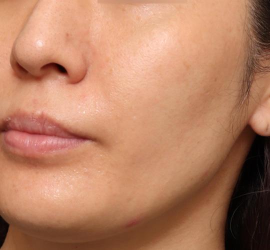 30代女性の肌管理毛穴スリークスキン（ダーマペン4） Before 症例写真