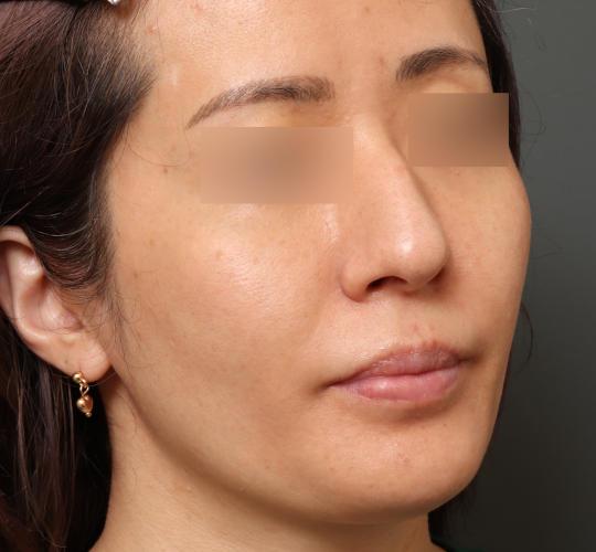 30代女性の肌管理毛穴スリークスキン（ダーマペン4） Before 症例写真