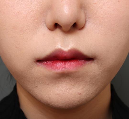 20代女性の鼻の整形 After 症例写真