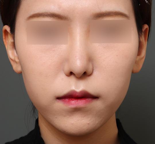 20代女性の人中短縮（リップリフト） After 症例写真