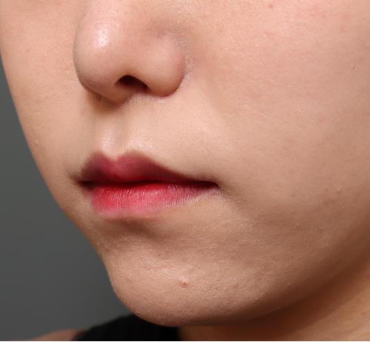 20代女性の人中短縮（リップリフト） After 症例写真