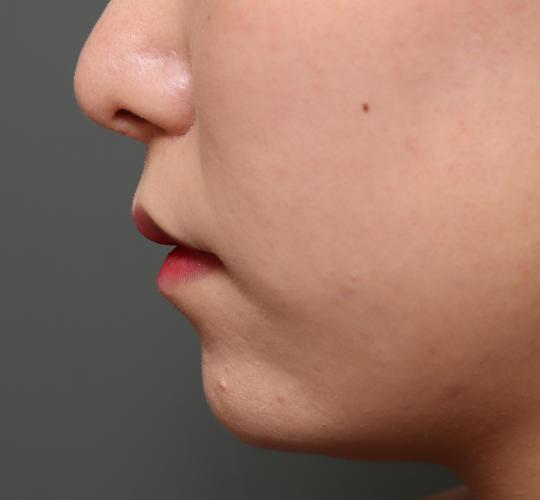 20代女性の人中短縮（リップリフト） After 症例写真
